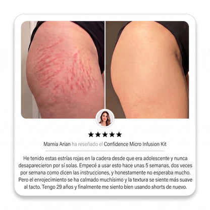 Sistema de Microinfusión PDRN