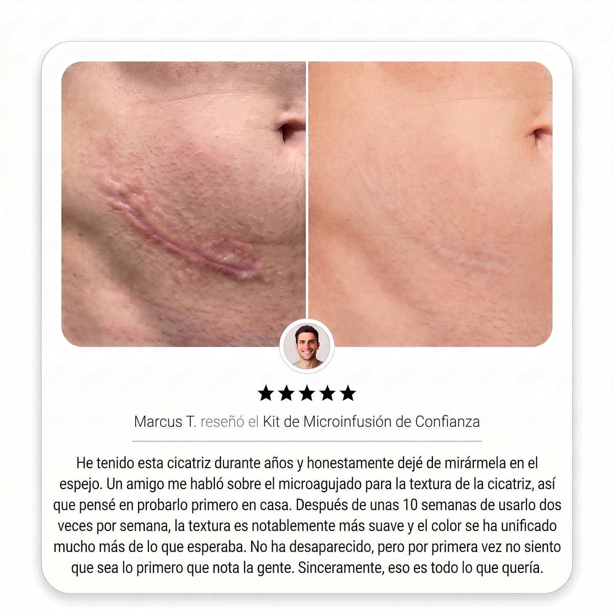 Sistema de Microinfusión PDRN