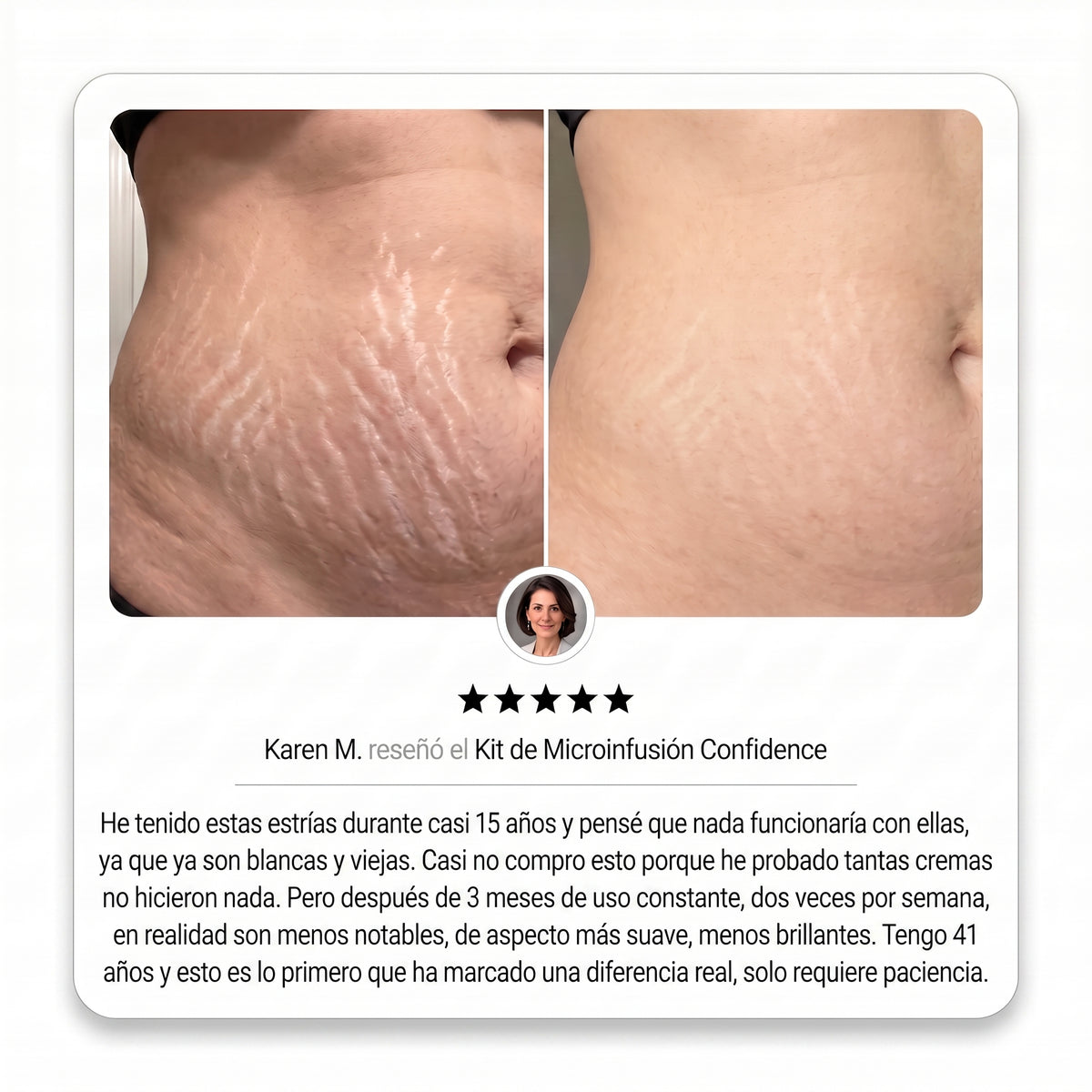 Sistema de Microinfusión PDRN