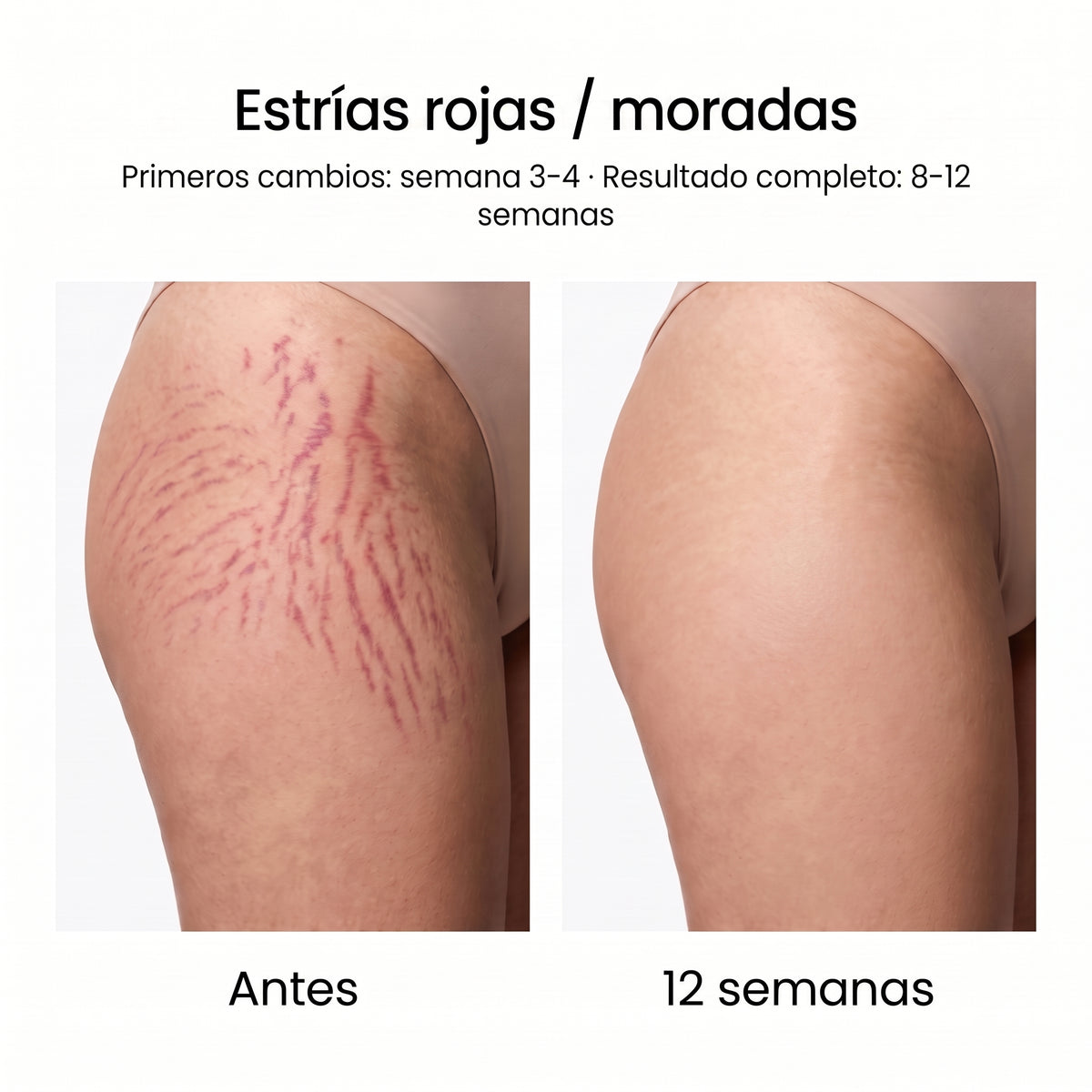 Sistema de Microinfusión PDRN