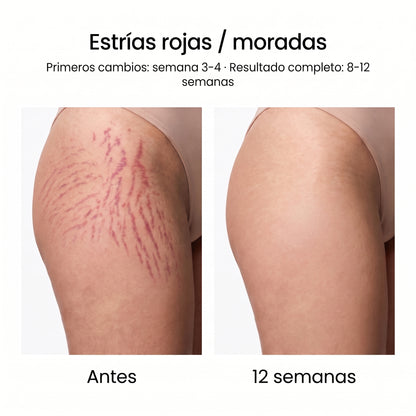 Sistema de Microinfusión PDRN