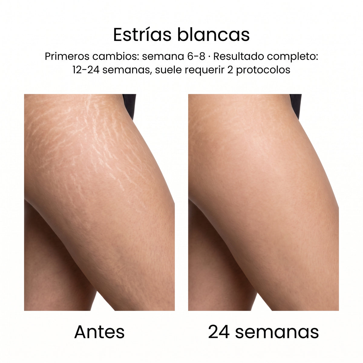 Sistema de Microinfusión PDRN